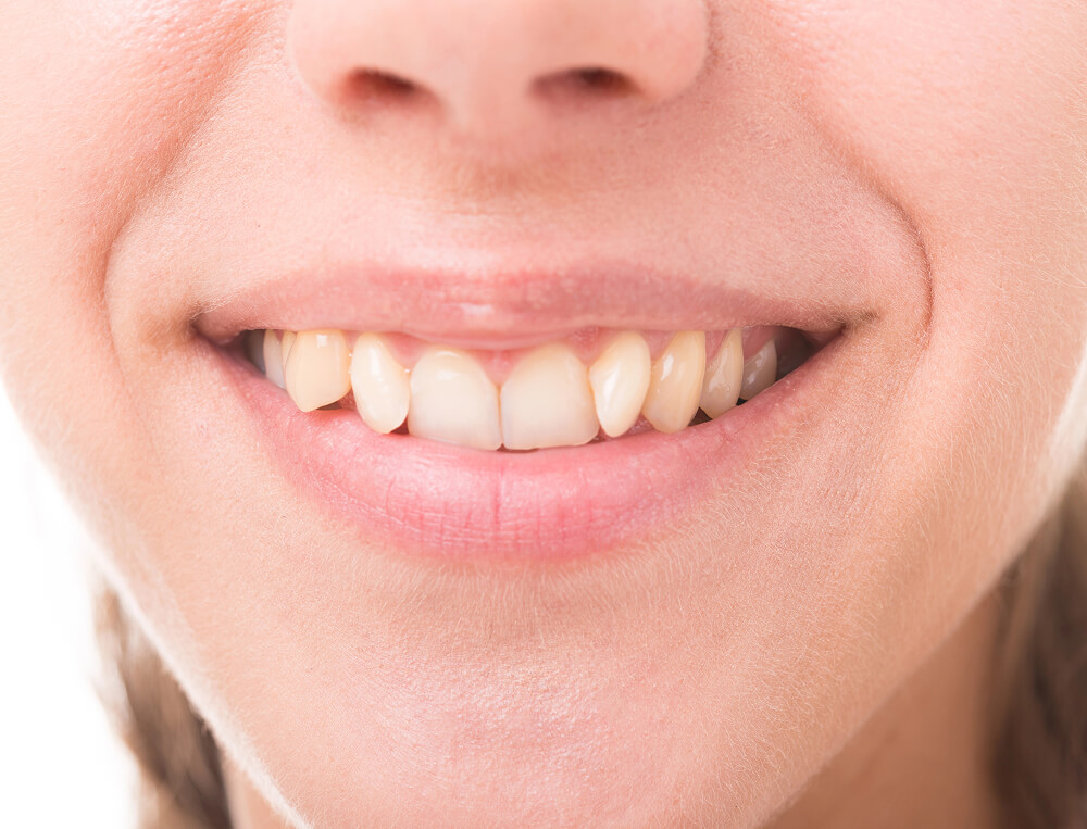 What Causes Crooked Teeth?