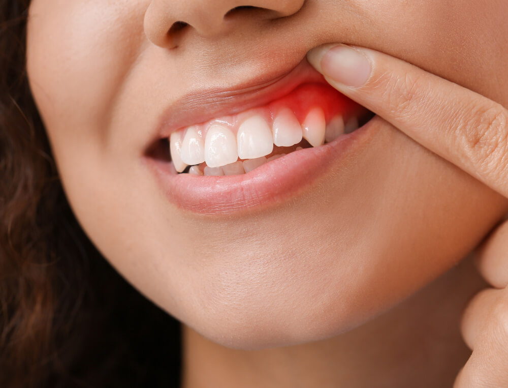 How to Spot and Treat Early Signs of Gum Disease