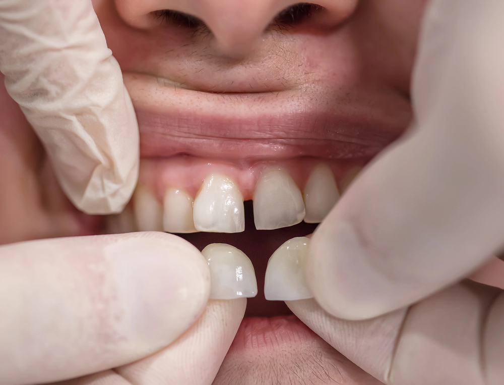 What’s the Difference Between a Bridge and an Implant?
